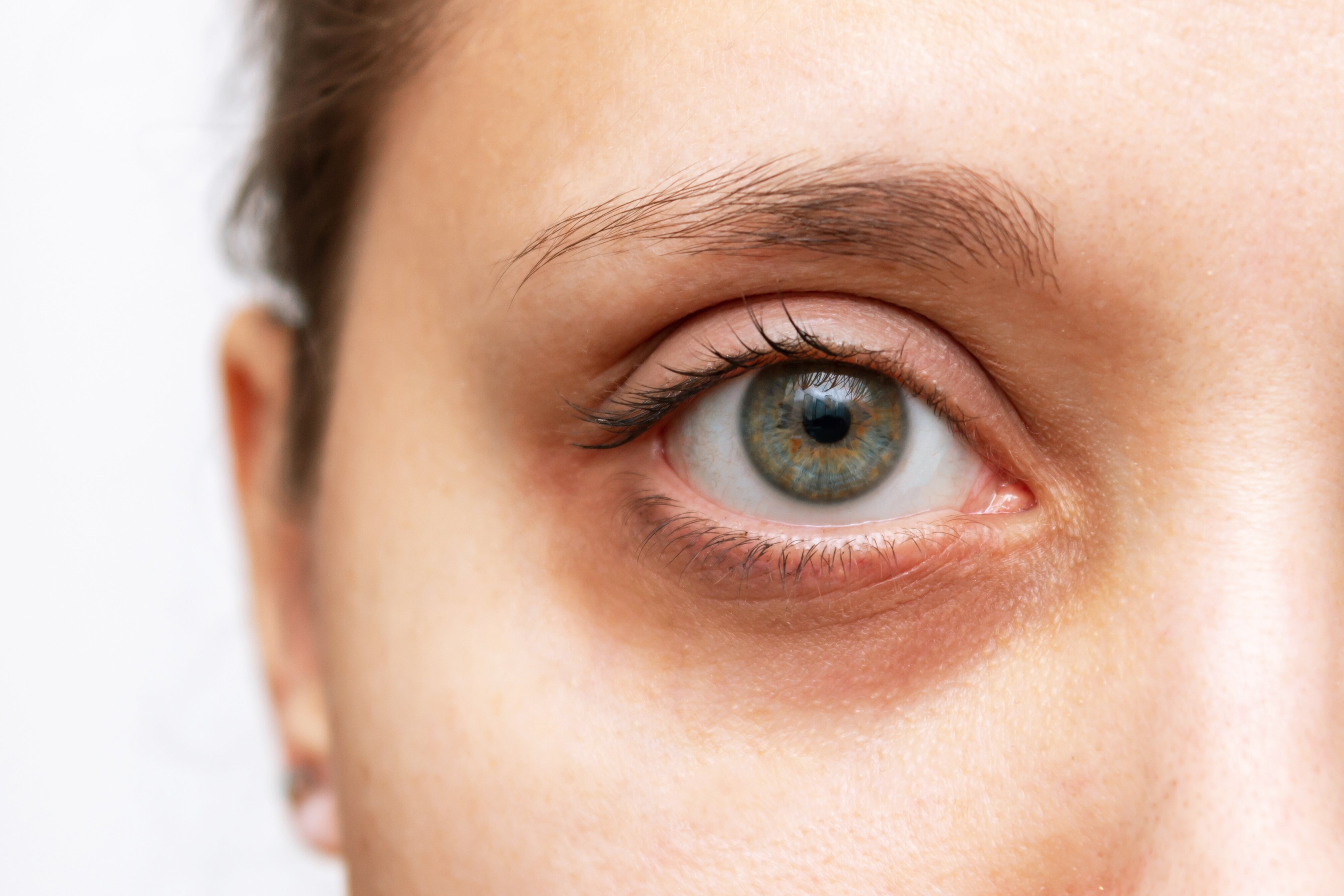 Dark Circles: From Concealers to Celebrations